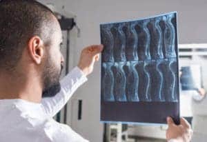 Spinal Cord Injury